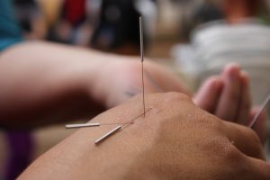 Acupuncturist in Meppel voert behandeling uit met traditionele Chinese geneestechniek voor pijnverlichting en gezondheid